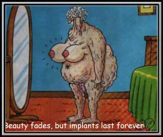 Implants Last Forever